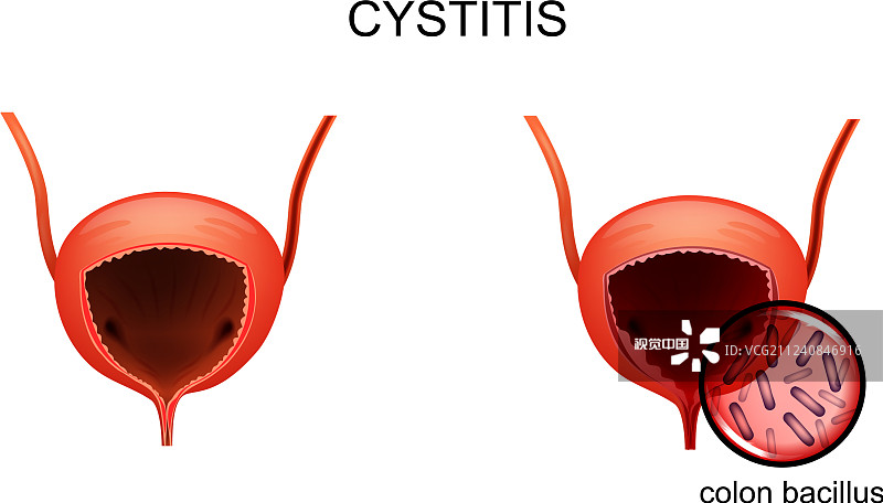 韓國首爾醫院公布：干細胞治療間質(zhì)性膀胱炎的I期研究結果