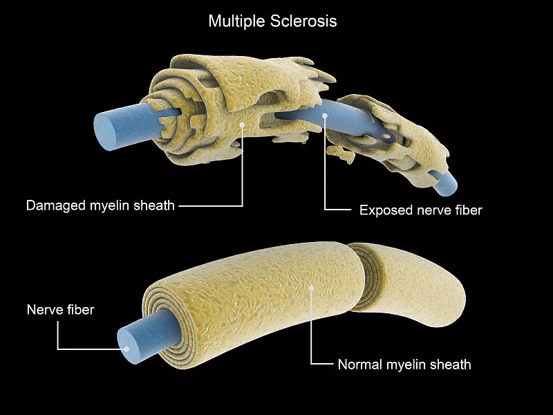 多發(fā)性硬化癥神經(jīng)元與正常神經(jīng)元的比較 多發(fā)性硬化癥神經(jīng)元與正常神經(jīng)元的比較