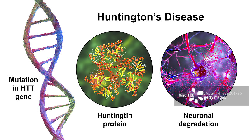 亨廷頓氏病，概念性說(shuō)明