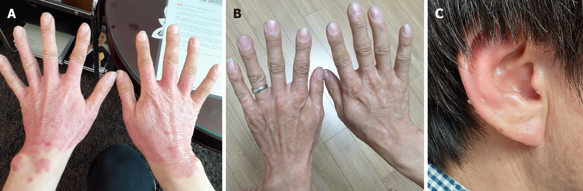 圖3：患者在治療期間和治療后病變部位的可見(jiàn)變化。 