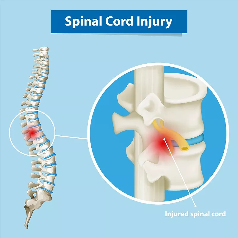 神經(jīng)干/祖細胞移植治療慢性脊髓損傷的臨床研究進(jìn)展