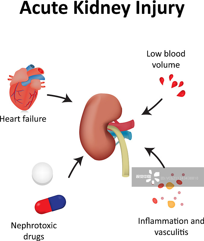 間充質(zhì)干細胞治療急性腎損傷的臨床研究進(jìn)展