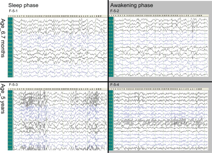 圖5：腦電圖。
