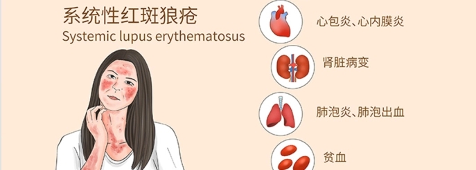 系統性紅斑狼瘡