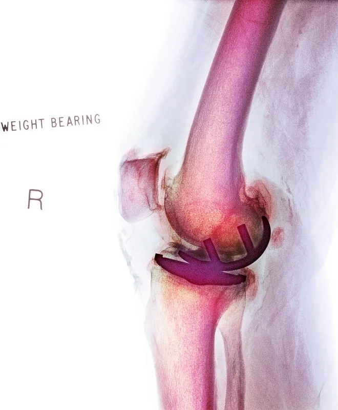 關(guān)節內移植干細胞治療膝骨關(guān)節炎：一項IIb期臨床試驗