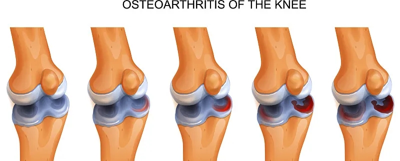 干細胞修復撕裂的無(wú)血管半月板軟骨:從體外優(yōu)化到首次人體研究