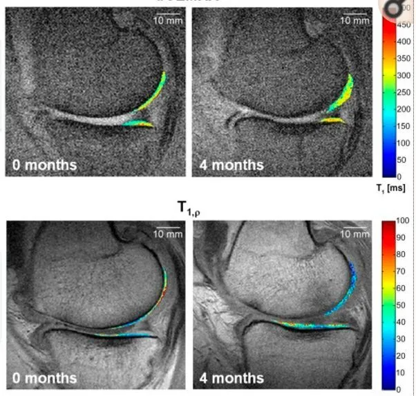 干細胞療法修復后疼痛顯著(zhù)減輕，半月板軟骨質(zhì)量提高。
