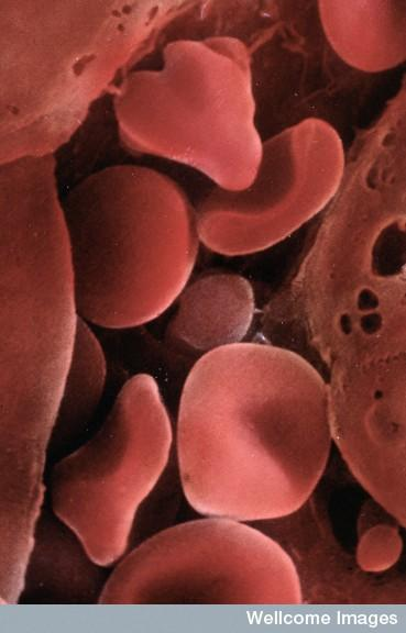 許多血液疾病已經(jīng)可以使用臍帶血進(jìn)行治療。