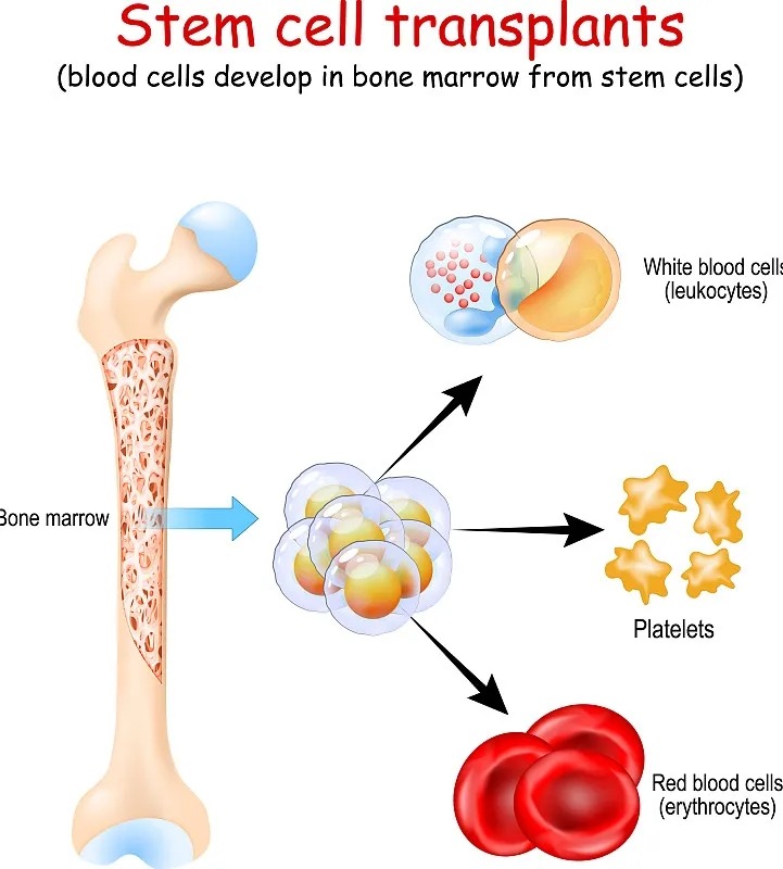 干細胞移植手術(shù)
