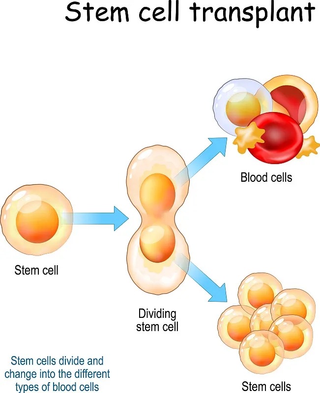 干細胞移植的五個(gè)階段是什么 干細胞移植的流程分為那五個(gè)階段