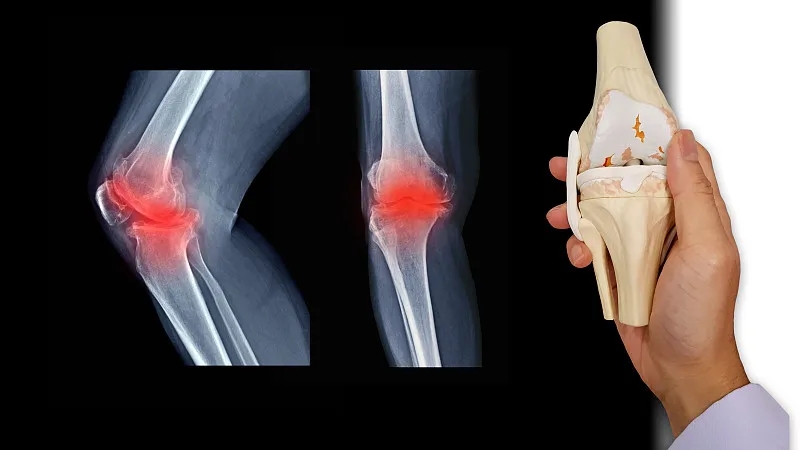 什么是骨關(guān)節炎-骨關(guān)節炎癥狀有哪些