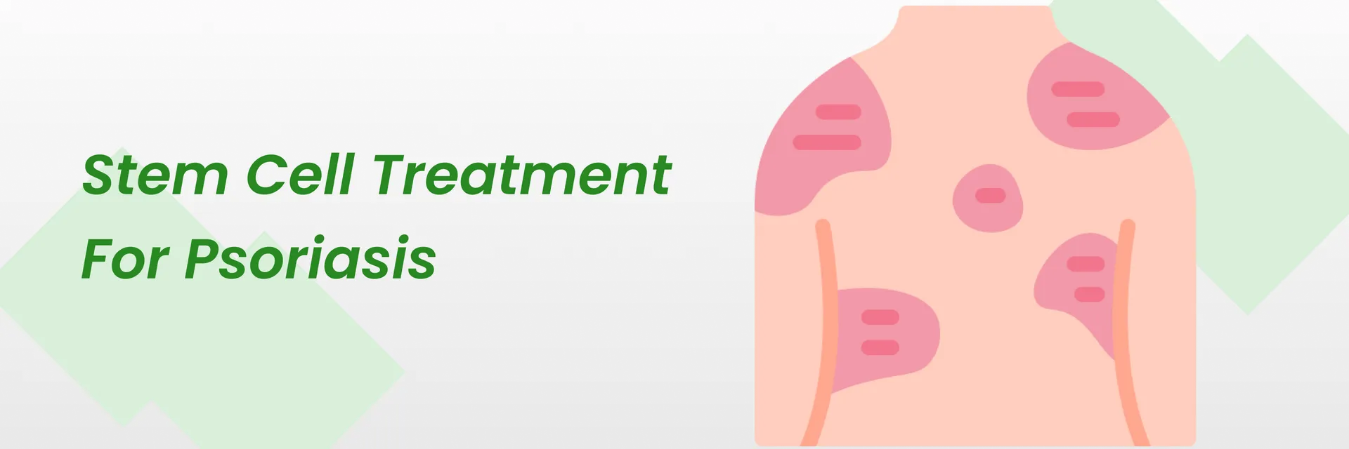 干細胞治療銀屑病2024（銀屑病患者的新希望）