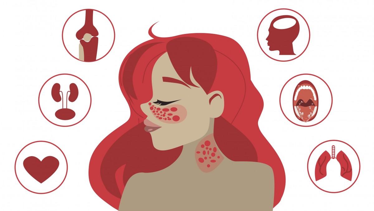 系統性紅斑狼瘡的癥狀是什么 系統性紅斑狼瘡的癥狀是什么