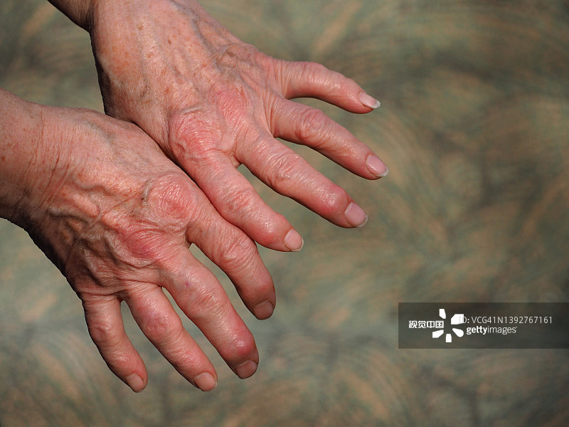 研究為治療類(lèi)風(fēng)濕性關(guān)節炎開(kāi)辟了新的治療途徑 研究為治療類(lèi)風(fēng)濕性關(guān)節炎開(kāi)辟了新的治療途徑