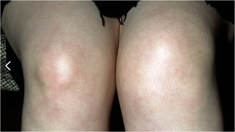 類(lèi)風(fēng)濕關(guān)節炎癥狀