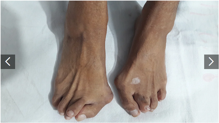 類(lèi)風(fēng)濕關(guān)節炎癥狀