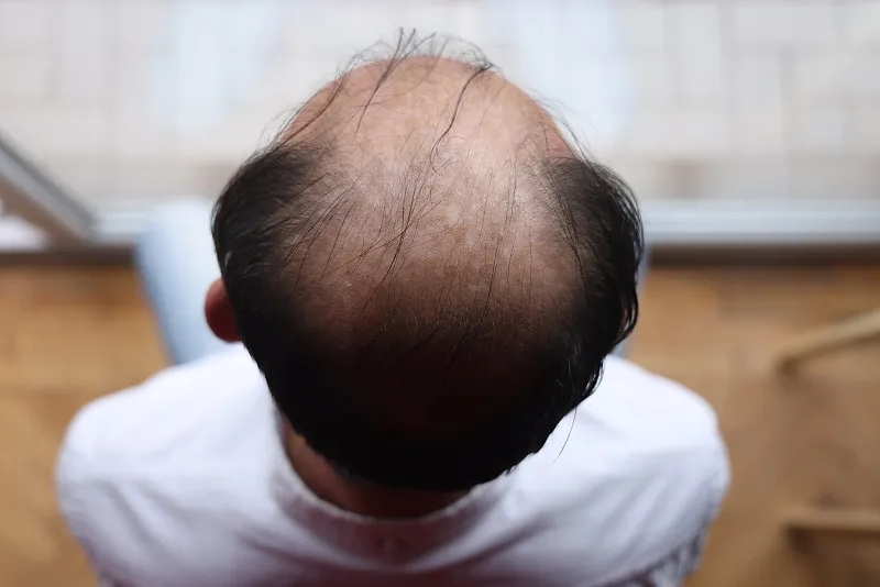 干細胞治療脫發(fā)的優(yōu)缺點(diǎn)