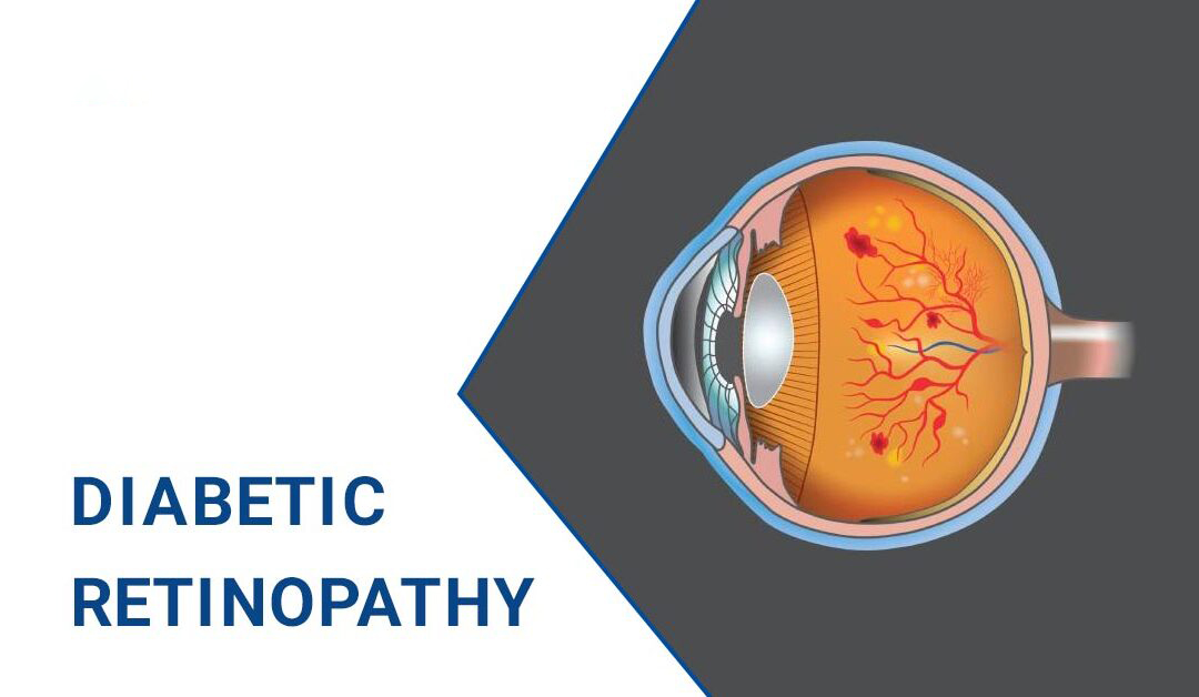 糖尿病視網(wǎng)膜病變–原因、階段和治療
