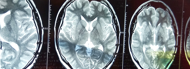 中風(fēng)患者的干細胞治療