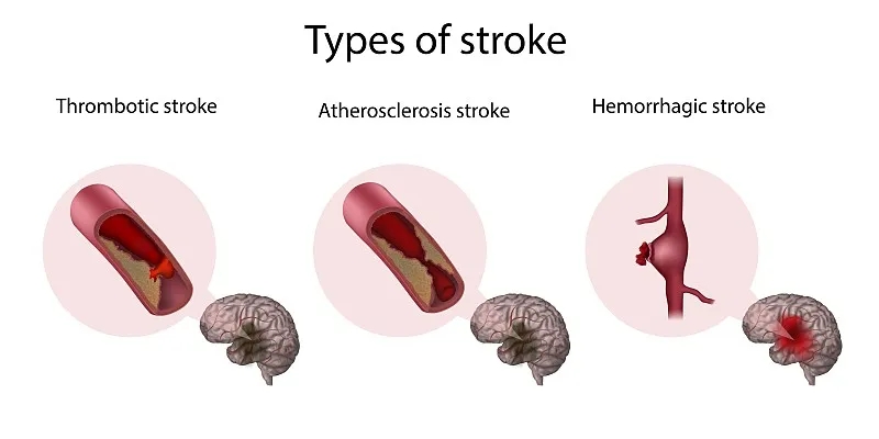 系統評估干細胞療法治療缺血性中風(fēng)的安全性及可行性