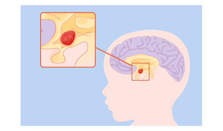 干細胞治療腦癱的成功率是多少？