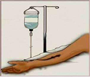 靜脈注射圖像。