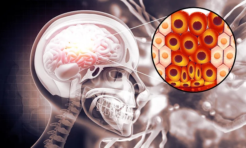 羊膜細胞療法治療缺血性中風(fēng)患者的I期試驗結果 羊膜細胞療法治療缺血性中風(fēng)患者的I期試驗結果