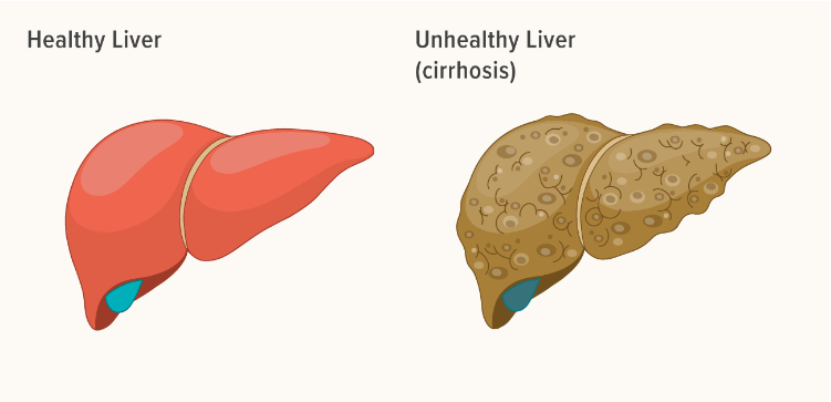 導致肝臟疾病的問(wèn)題及其原因