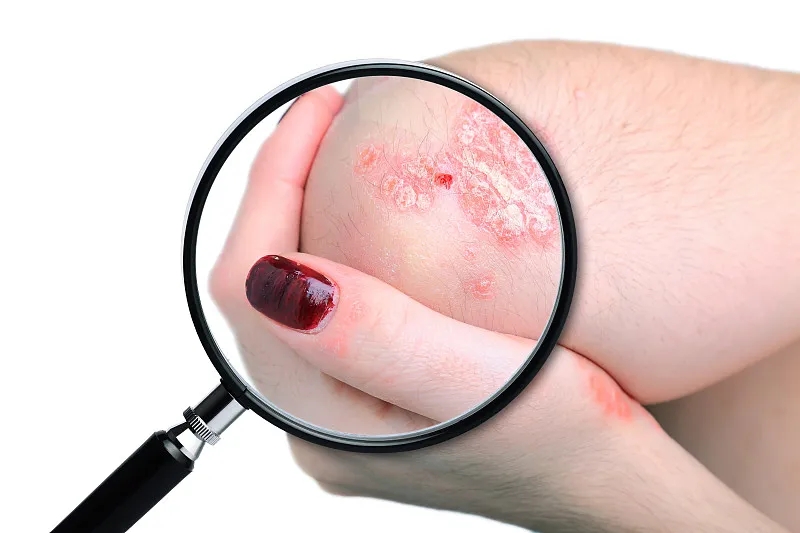 國內已有7項臨床研究項目，干細胞治療銀屑病，未來(lái)可期！