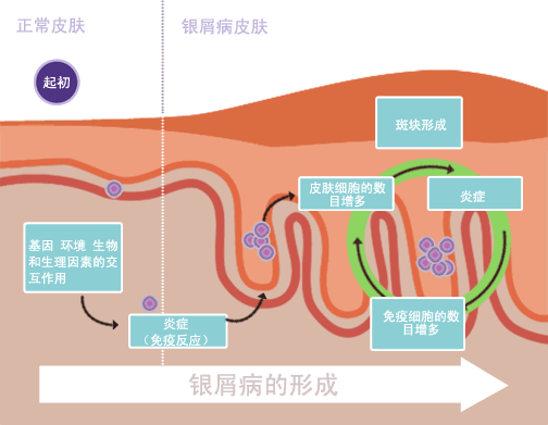 銀屑病治愈：是科學(xué)事實(shí)還是虛假希望？
