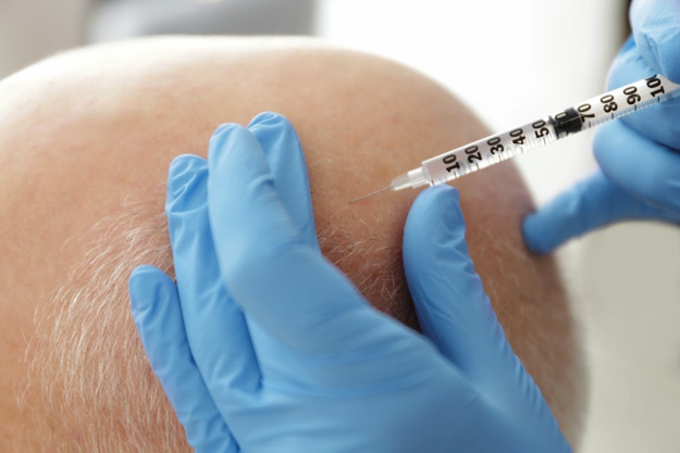 頭發(fā)修復過(guò)程是怎樣的？ |  干細胞治療脫發(fā)