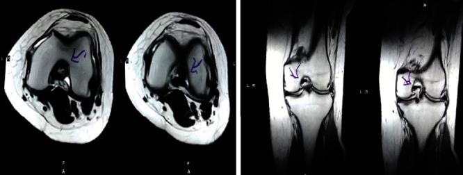 圖2：治療后MRI顯示內側和外側半月板后角的撕裂有所改善?；颊呓?jīng)歷了癥狀改善以及進(jìn)行日常生活活動(dòng)的能力增強。