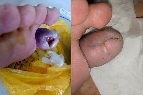 圖4：糖尿病潰瘍修復示例–干預前（左）和干預后（右）。