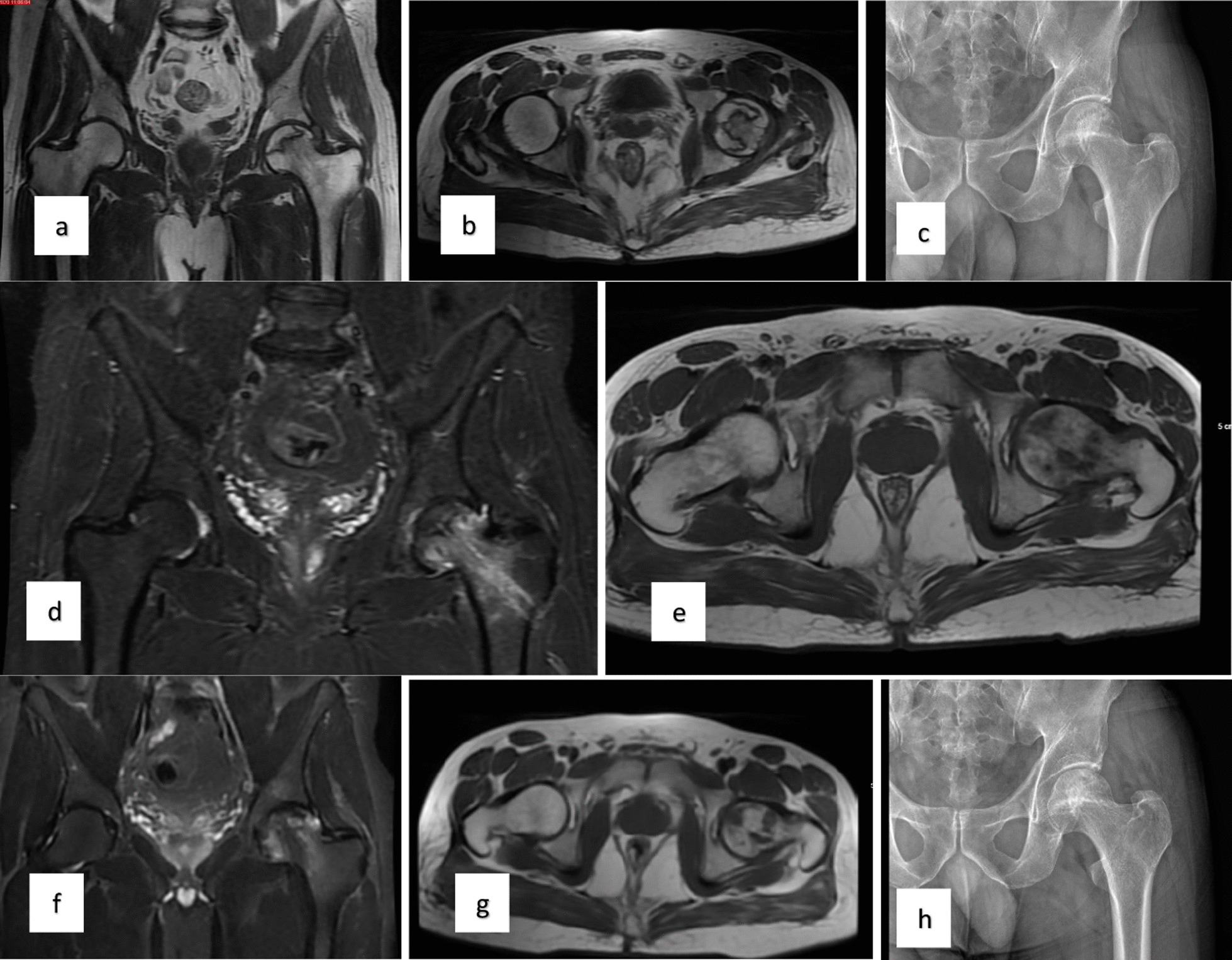 對患者的術(shù)前、3個(gè)月、6個(gè)月、1年和2年隨訪(fǎng)進(jìn)行評估（圖1）。