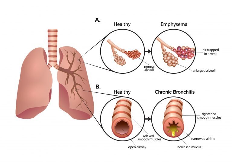 圖2：慢性阻塞性肺疾病 (COPD) 是一組導致呼吸困難的肺部疾病。A.肺氣腫導致肺泡氣囊受損和僵硬?？諝獗焕г诜闻葜?，導致呼氣困難。B.慢性支氣管炎會(huì )導致氣道腫脹和粘液增多。多余的粘液使呼吸困難并導致慢性咳嗽