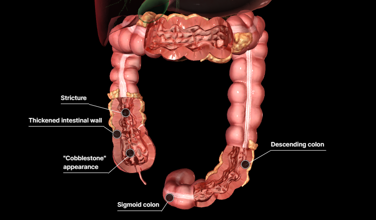 △克羅恩病3D圖示，來(lái)源：默沙東診療手冊