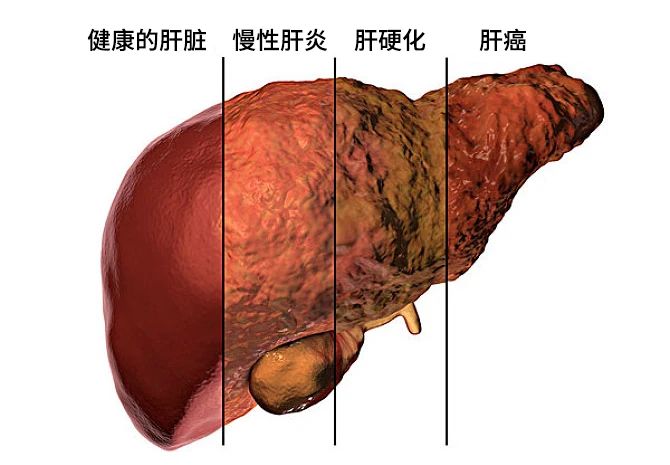 不同原因的肝損害發(fā)展主要分為三個(gè)階段：肝炎-肝硬化-肝癌。
