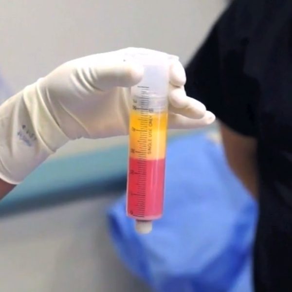 購買(mǎi)和使用低溫保存（冷凍）的臍帶干細胞是許多干細胞治療提供者的另一種流行選擇。