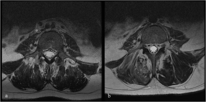 圖1：6號患者輸注前和輸注后MRI。