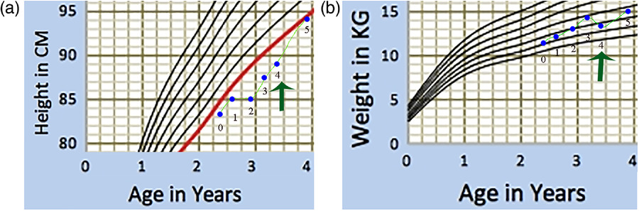 圖1：一名患有嚴重III型OI的男孩的生長(cháng)曲線(xiàn)圖。