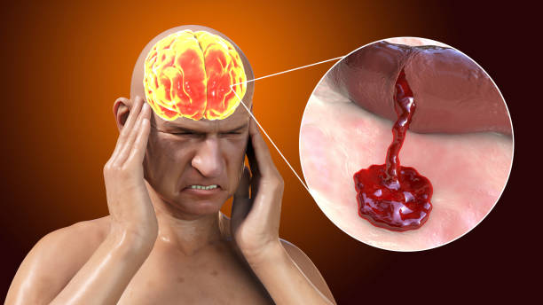 了解缺血性中風(fēng)的病理生理學(xué)：當前療法的基礎和干細胞療法的機遇