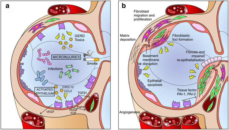 圖1：IPF發(fā)病機制示意圖。