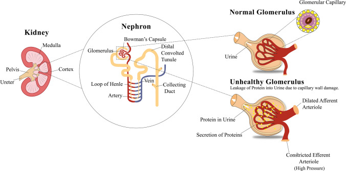 圖1：導致糖尿病腎病的原因，即糖尿病引起的腎臟疾病