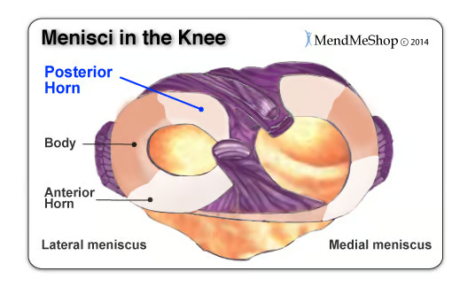 后角半月板撕裂癥狀、原因以及治療方法