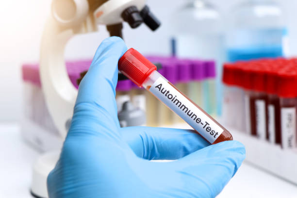 干細胞在類(lèi)風(fēng)濕關(guān)節炎、系統性紅斑狼瘡、銀屑病等自身免疫性疾病中的治療作用