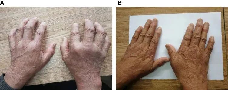 一名68歲男性被診斷患有類(lèi)風(fēng)濕性關(guān)節炎治療前后對比