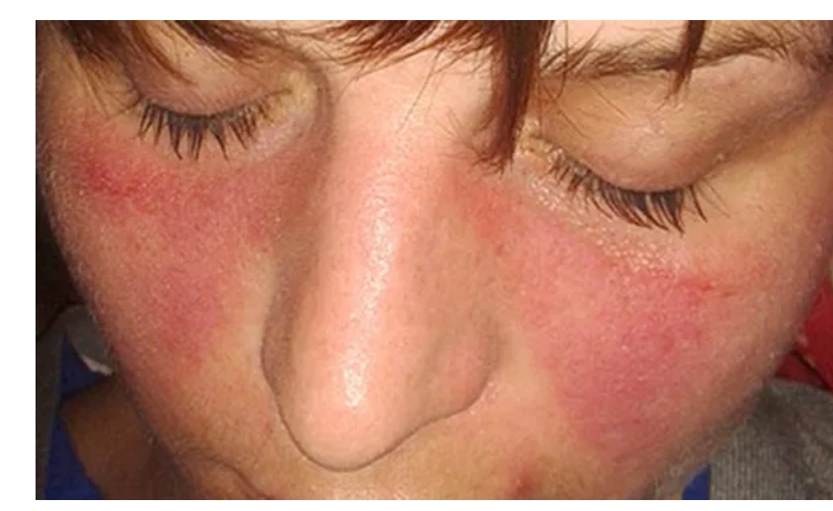 系統性紅斑狼瘡癥狀、病因和治療方法