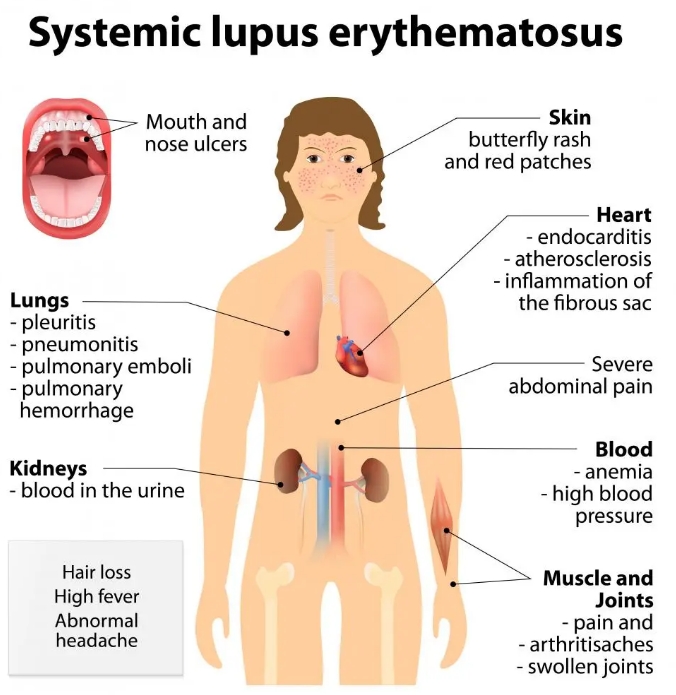 什么是系統性紅斑狼瘡？干細胞治療系統性紅斑狼瘡的臨床案例有哪些?
