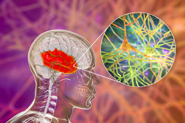 如何治療精神分裂癥？