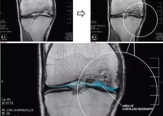 干細胞治療膝骨關(guān)節炎臨床案例